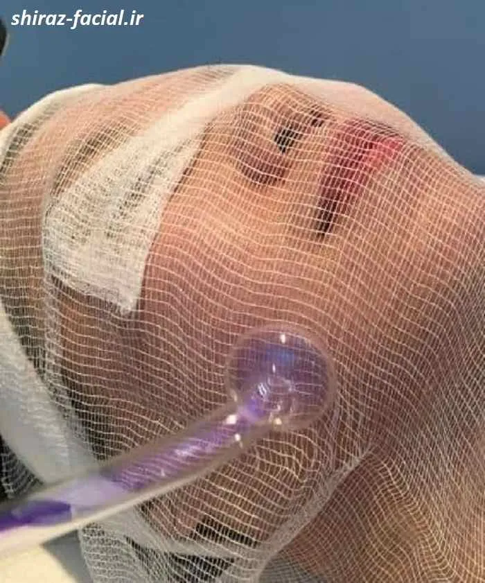 هزینه فیشیال صورت هزینه فیشیال صورت